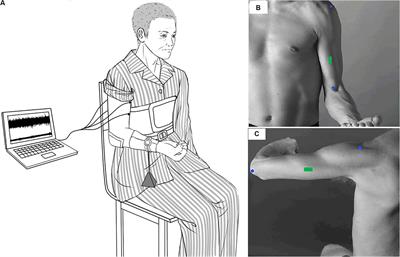 Muscle Fatigue Enhance Beta Band EMG-EMG Coupling of Antagonistic Muscles in Patients With Post-stroke Spasticity